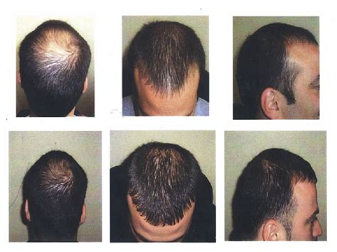 What is Laser Therapy for Hair Loss and Its Benefits