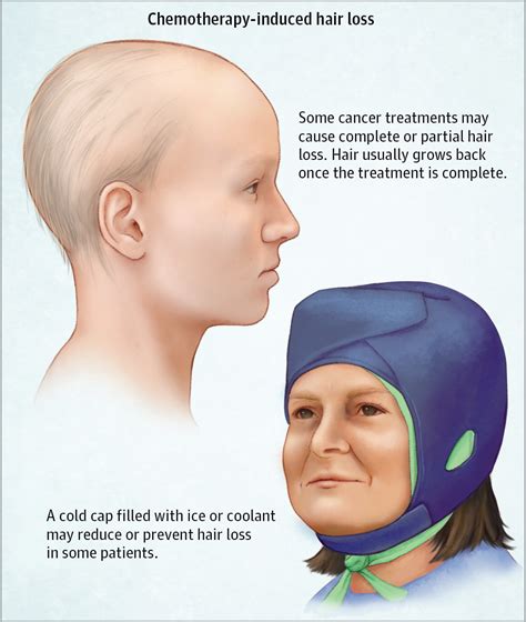 Hair Loss Prevention From Chemotherapy https://www.hairlossmenwomen.com ...