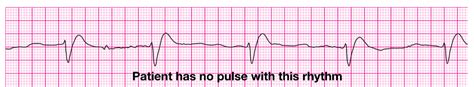 Pulseless Electrical Activity | Time of Care