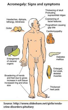 28 Acromegaly ideas | endocrine disease, growth hormone, rare disorders