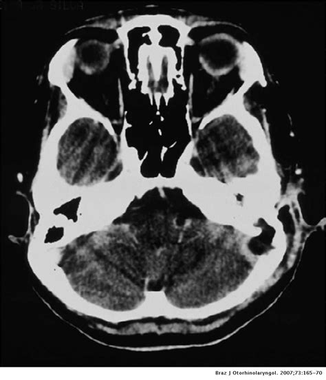 Sigmoid Sinus Thrombosis Associated to Chronic Otitis Media | Brazilian ...