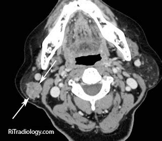 RiT radiology: Parotid Mass