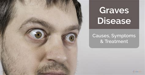 Graves Disease: Causes, Symptoms and Treatment