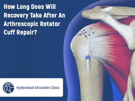 How Long Does Will Recovery Take After An Arthroscopic Rotator Cuff ...