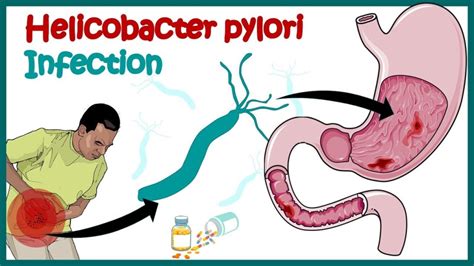 HELICOBACTER PYLORI INFECTION (H. PYLORI INFECTION) – The African Doctor