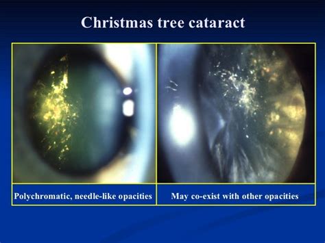 ophthalmology.Diseases of the lens.(dr.baxtyar)