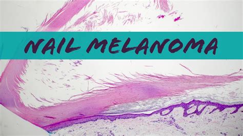 Acral Lentiginous Melanoma Histology