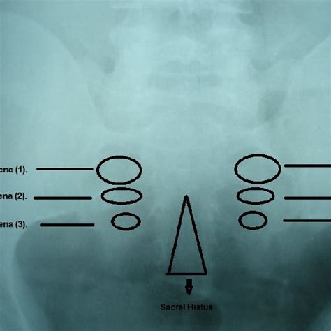 Anteroposterior view of male pelvic radiograph showing sacral hiatus... | Download Scientific ...