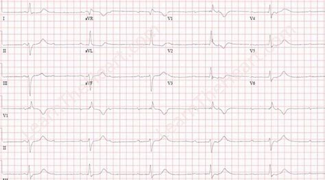 3rd Degree AV Block ECG 6 | LearntheHeart.com