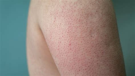 Keratosis Pilaris Treatment: From Creams to Lasers