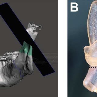 (A and B) Digital planning of the bilateral mandibular osteotomy (a ...