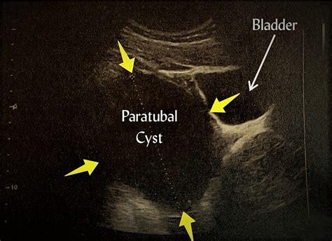 Cureus | Pueperal Paratubal Cyst Torsion and Secondary Fallopian Tube Torsion Without Ovarian ...