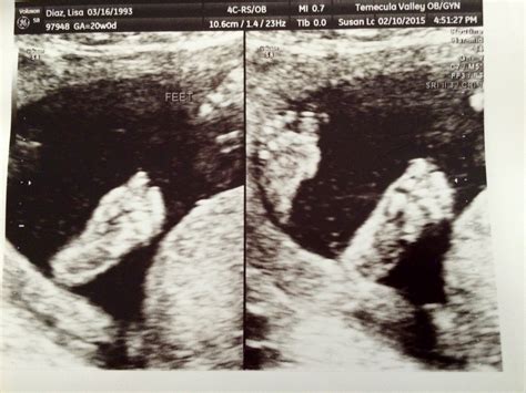 2nd Trimester Ultrasound Pics – Myk & Lisa (& Levi)