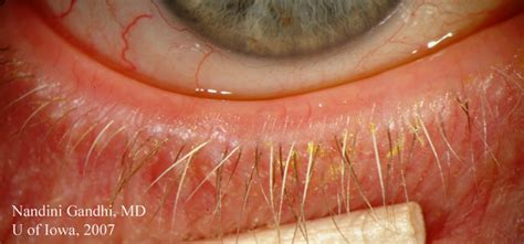 The Patient's Guide to Dry Eye Syndrome: Ocular Rosacea - Eyedolatry