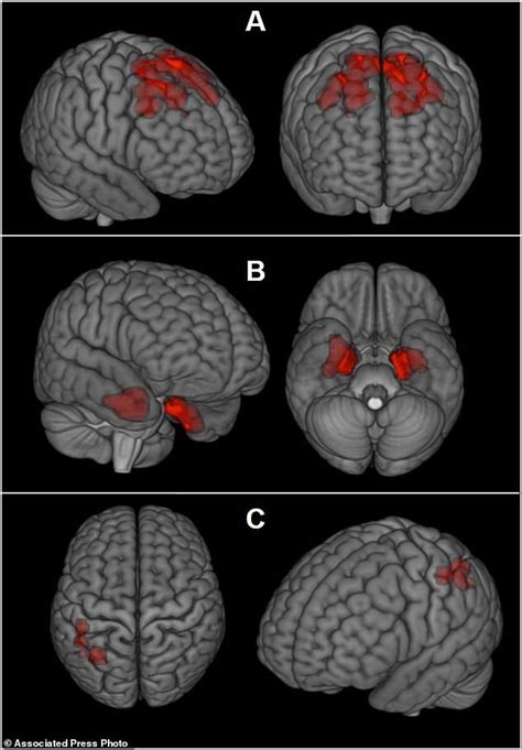 Brain scans may reveal signs of CTE in living NFL players | Daily Mail Online