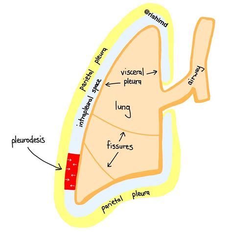 Mi viejo maletin: Pleurodesis