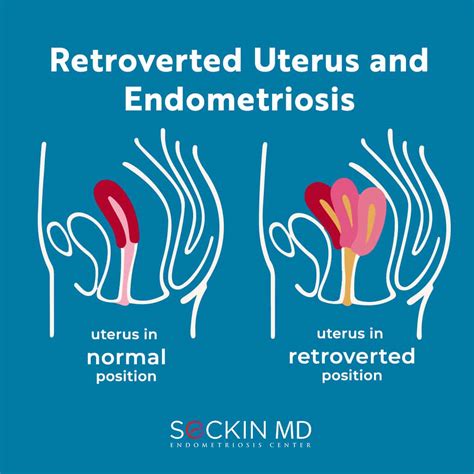 Retroverted Uterus