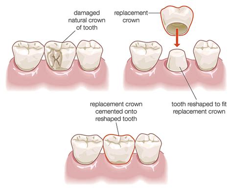 Cracked tooth syndrome