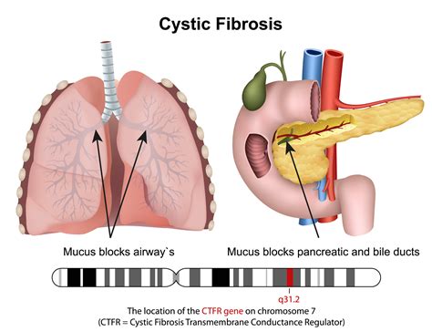 Cystic Fibrosis Symptoms : How Cystic Fibrosis Is Diagnosed / Fat malabsorption in cystic ...