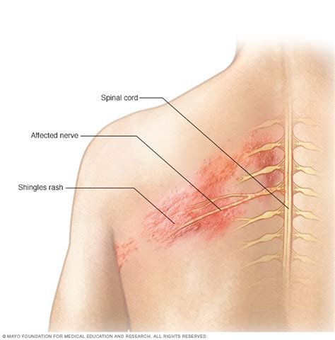 Shingles - Symptoms and causes - Mayo Clinic