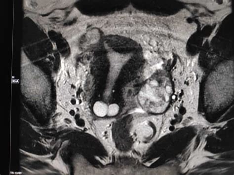 Incidental arcuate uterus on pelvic MRI with broad fundal indentation ...