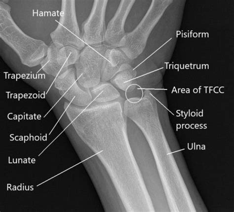 Wrist Pain - Causes and Management | Complete Orthopedics | Multiple NY Locations