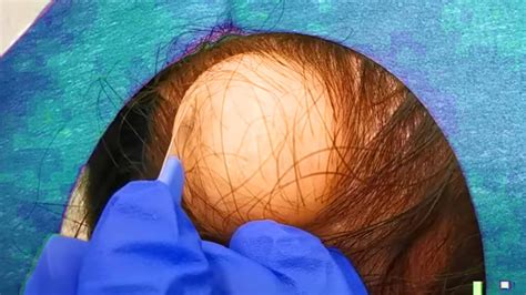 Giant Scalp Cyst Popping! DB's Pilar Cyst Removal!