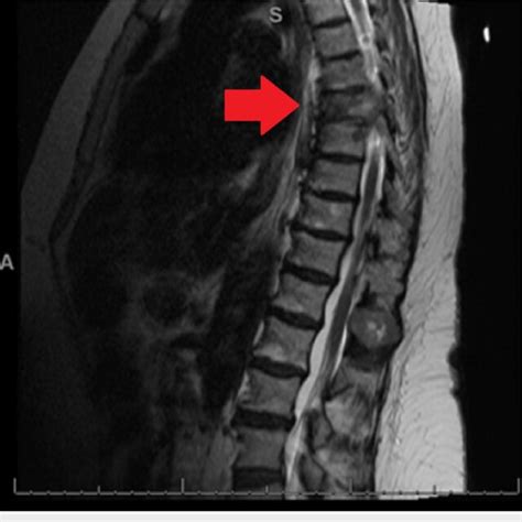 Thoracic spine lesions via magnetic resonance imaging T2 weighted... | Download Scientific Diagram