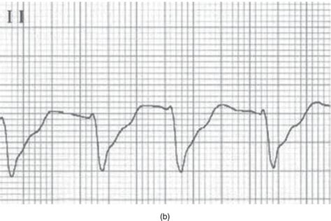 Wide QRS Complex Tachycardia | Anesthesia Key