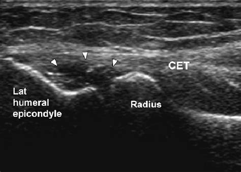 Common Extensor Tendon Origin Tear