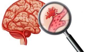 What Is A Hemorrhagic Stroke? Causes, Risk Factors, And Treatment ...