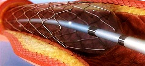 Trans-Luminal Coronary Angioplasty (PTCA) - My Blog