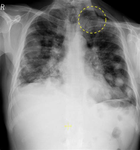 Lung metastases from head and neck cancer - Radiology at St. Vincent's ...