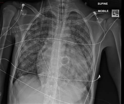 Rheumatic fever chest x ray - wikidoc