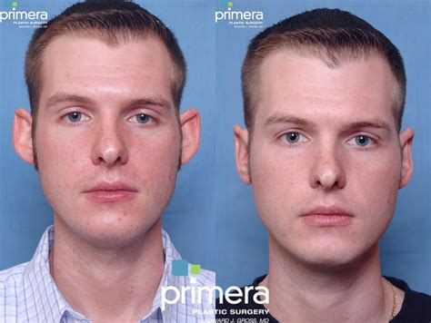 Ear Surgery (Otoplasty) Before and After Pictures Case 250 | Orlando, Florida | Primera Plastic ...