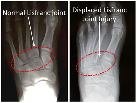 Figure 1B -Lisfranc Injury -x-ray image Normal vs Injured | Ehlers Danlos Syndrome + Postural ...