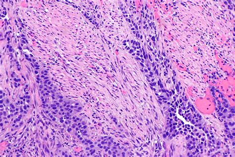 Muscularis propria invasion in the urinary bladder - Libre Pathology