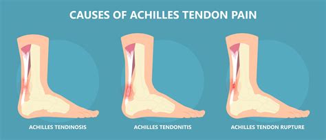 Achilles Tendon Injury: Symptoms, Causes, Treatment & Recovery