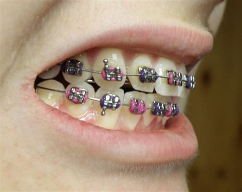 Do I Need Braces In Marlboro, NY? | Northeastern Braces