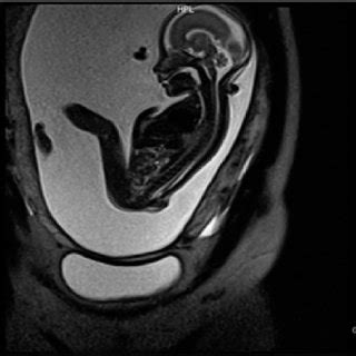 (PDF) Prenatal diagnosis of lipomyelomeningocele by ultrasound and magnetic resonance imaging (MRI)