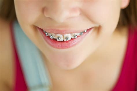 Orthodontic Treatment For Children Ballina | Smart Smile Orthodontics