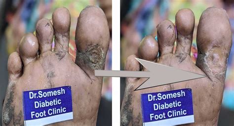 Diabetic Gangrene stages-Great Toe Base - Podiatry Doctor