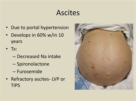 Ascites Liver Disease