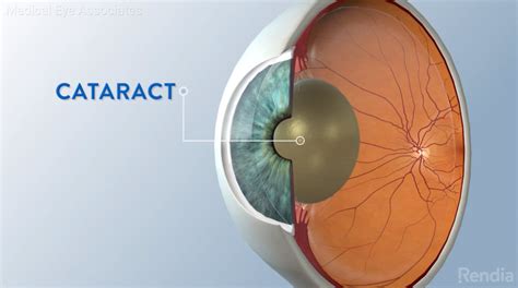 Cataract: Everything You Need to Know - Medical Eye Associates