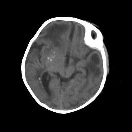 Cmv Retinitis Mri