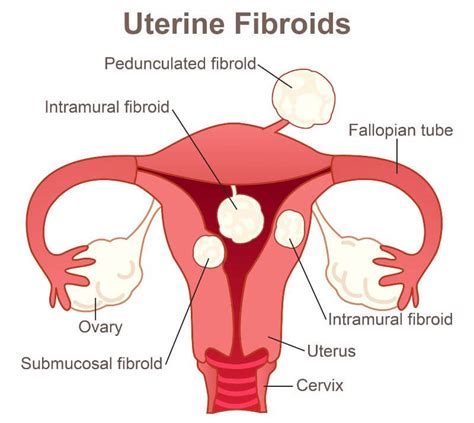 Uterine fibroids: causes, symptoms, and treatment