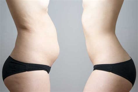 Vaser Lipo Recovery - Hints and Tips ensure fabulous results