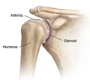 Understanding Glenohumeral Osteoarthritis | Saint Luke's Health System