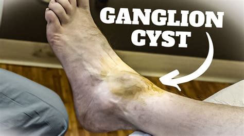 Ganglion Cyst Foot Surgery Recovery Time [Causes & Best Treatment]