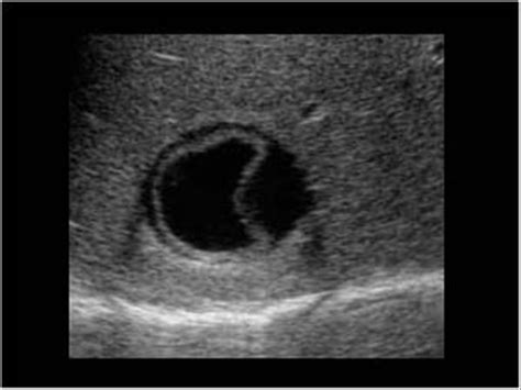 Abdomen and retroperitoneum | 1.1 Liver : Case 1.1.5 Hydatid cysts ...